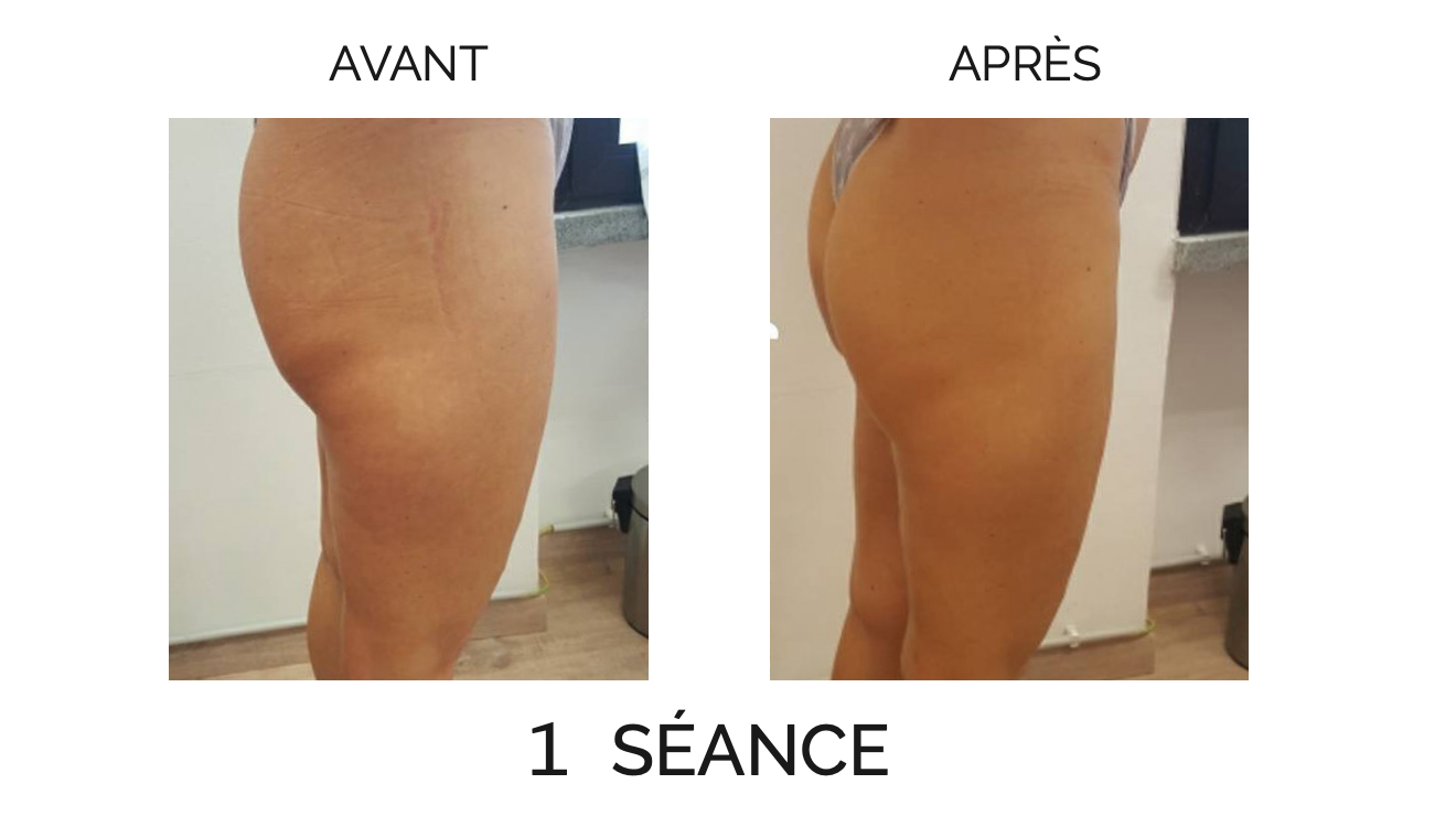 Avant/Après Pressothérapie jambes/fesses Avant/Après Pressothérapie jambes/fesses